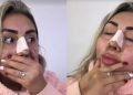 Naya Fácil se operó la nariz